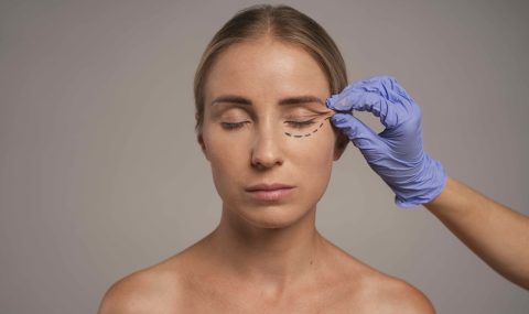 Close-up of a woman undergoing aesthetic procedure preparation with pre-surgery markings near the eye, representing cosmetic transition after stopping dermal fillers