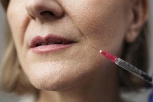 Close-up of a dermal filler or botulinum toxin injection targeting the nasolabial fold area to smooth deep wrinkles – featured in Toxifillers.com educational blog.